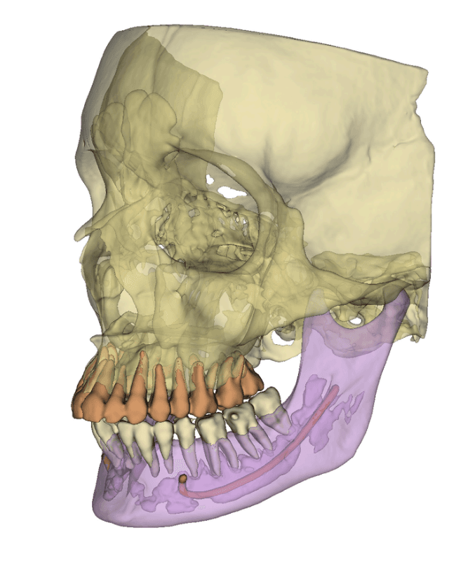 Real CT scan result with 5 structures (upper skull, mandible, upper/lower teeth, mandibular canal) segmented in color