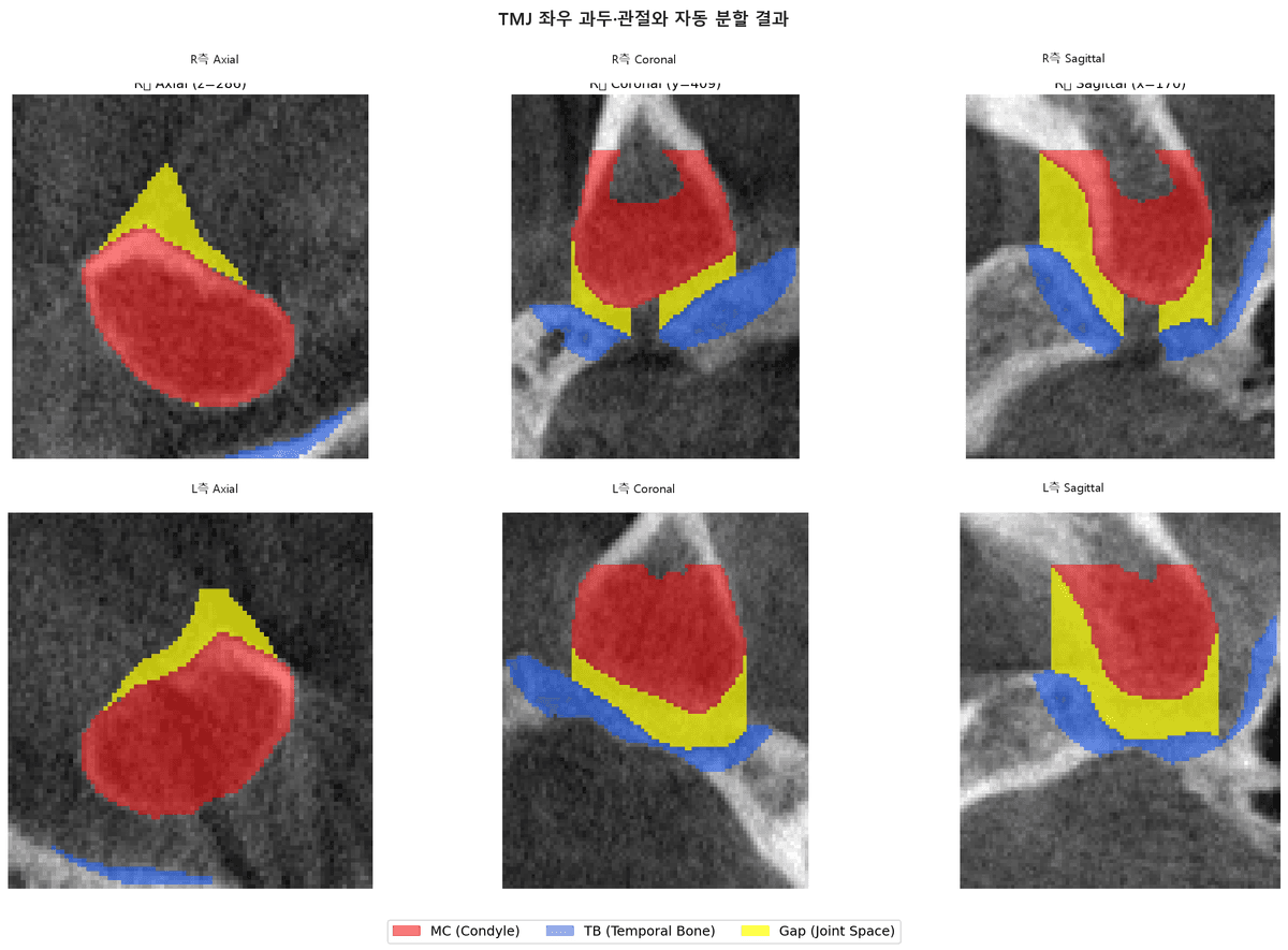 TMJ 3D analysis result